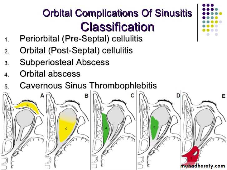 Sinusitis