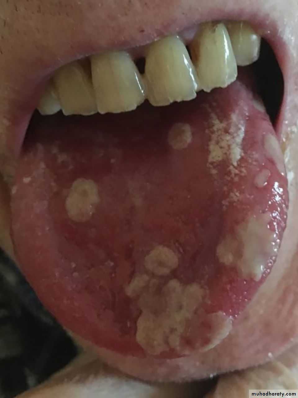 Immunodefeciency