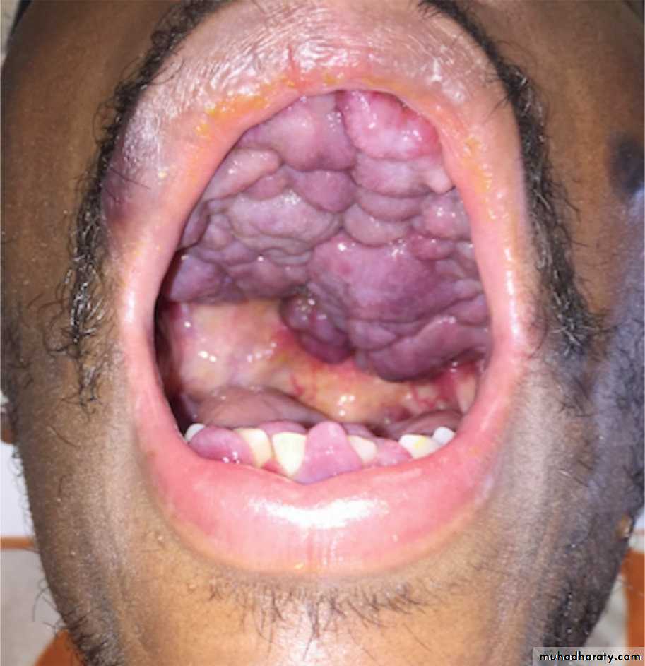 Immunodefeciency