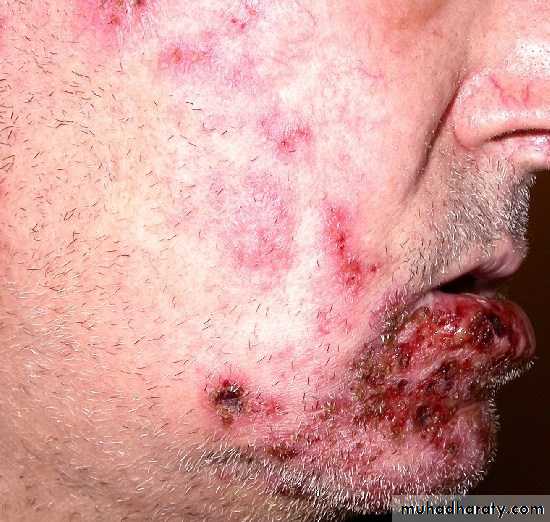 Immunodefeciency