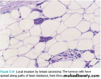 Neoplasia