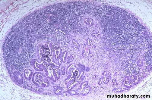 Neoplasia