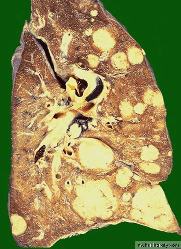 Neoplasia