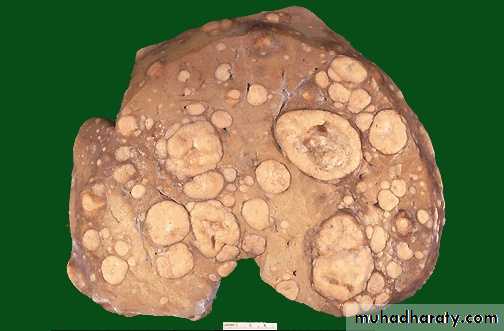 Neoplasia