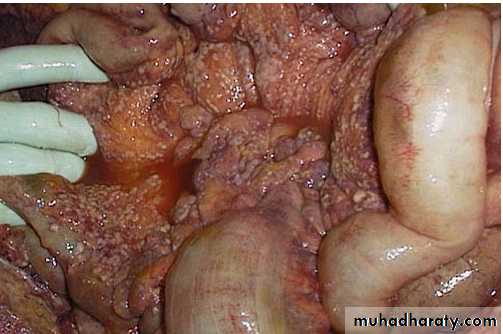 Neoplasia