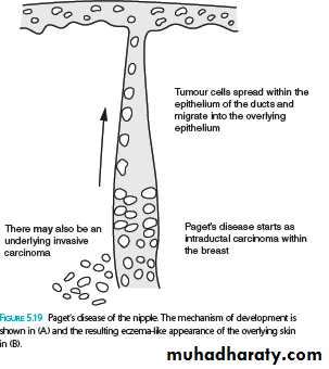Neoplasia