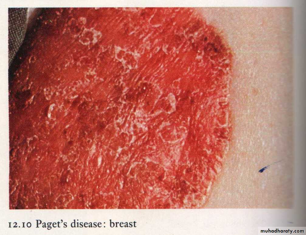 Neoplasia