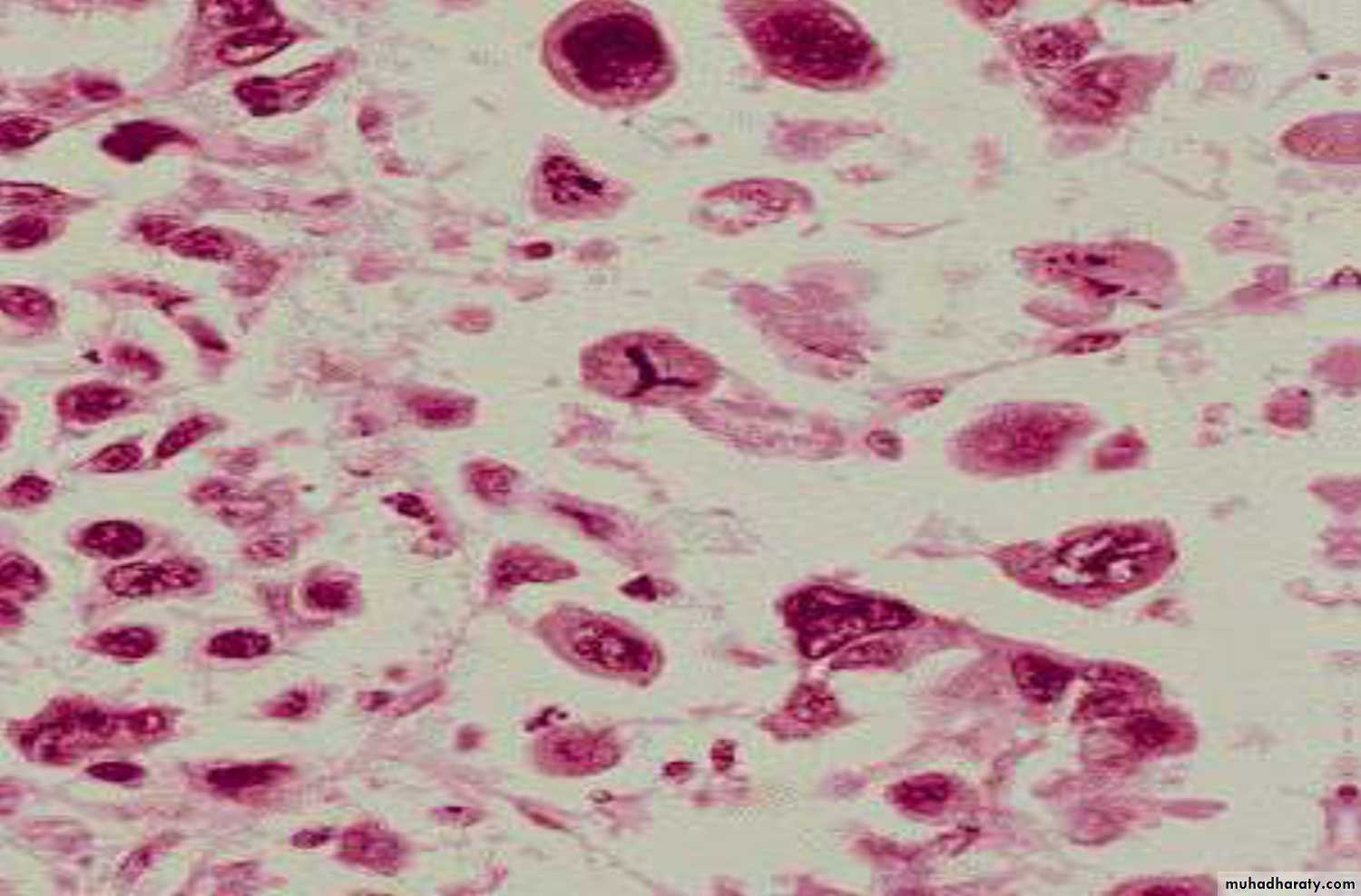 Neoplasia