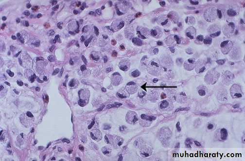 Neoplasia