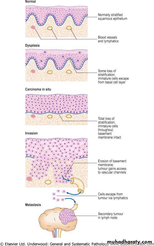 Neoplasia