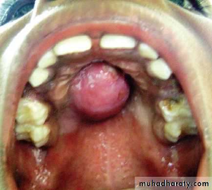 cyst