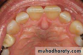 cyst