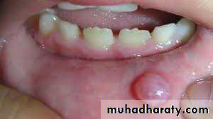 cyst