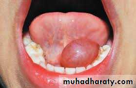 cyst