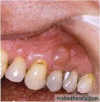 cyst