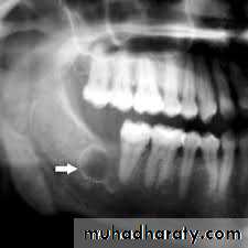 cyst