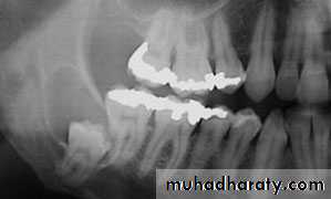 cyst