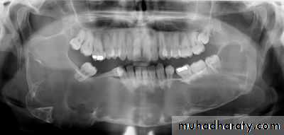 cyst