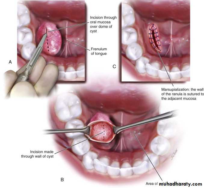 cyst