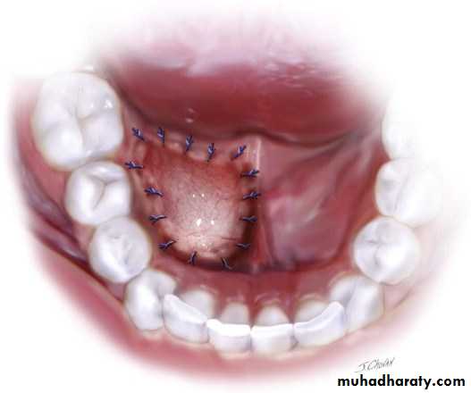 cyst
