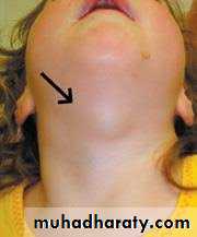 cyst