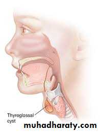cyst