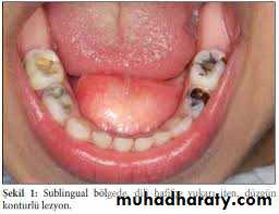 cyst