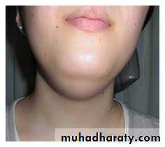 cyst