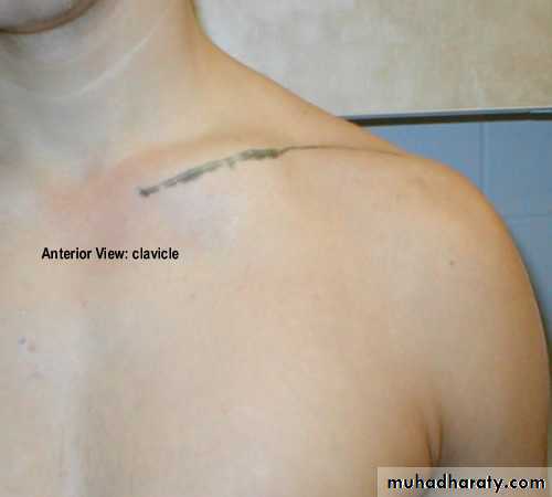 cyst