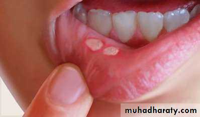 Ulcer