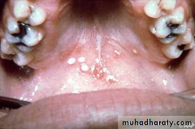 Ulcer