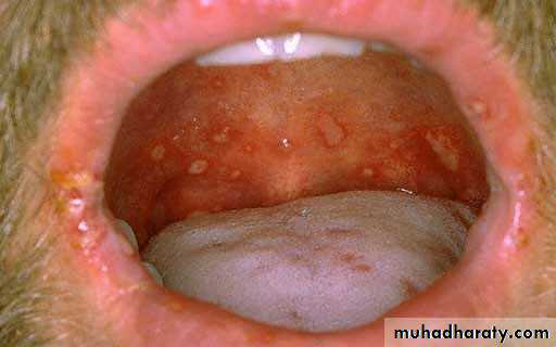 Ulcer
