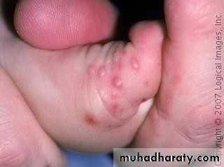 Ulcer