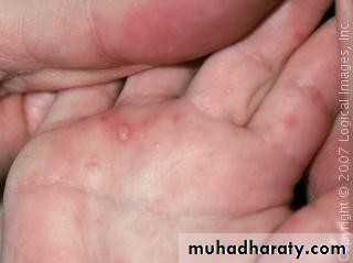Ulcer