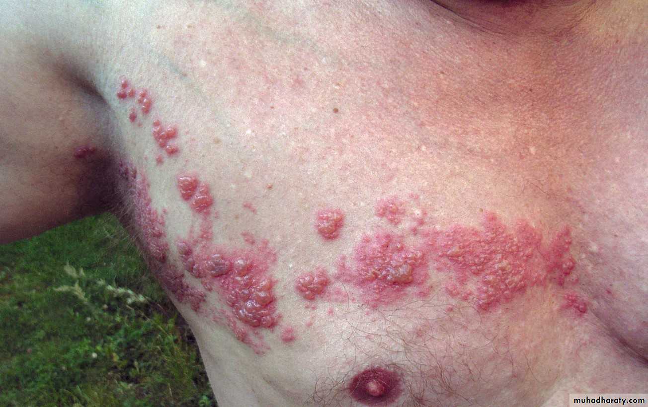 Ulcer