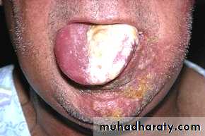 Ulcer