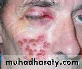 Ulcer