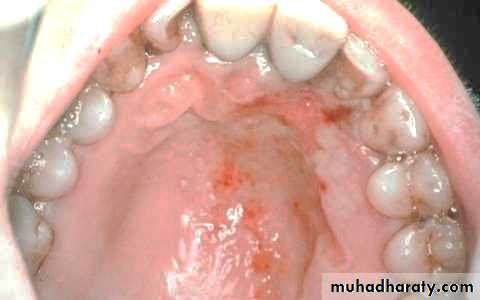Ulcer