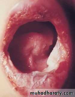 Ulcer