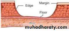 Ulcer