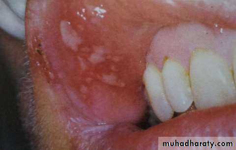 Ulcer