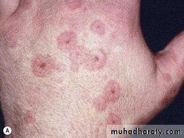Ulcer