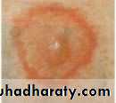 Ulcer