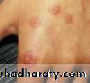 Ulcer