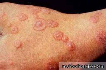 Ulcer