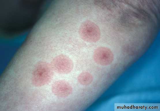 Ulcer