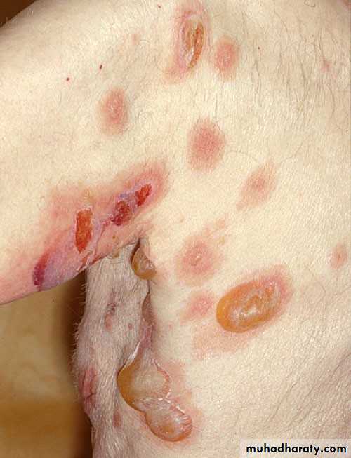 Ulcer