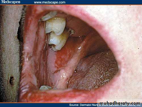 Ulcer