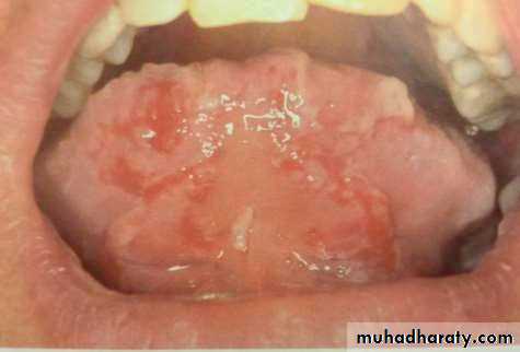 Ulcer