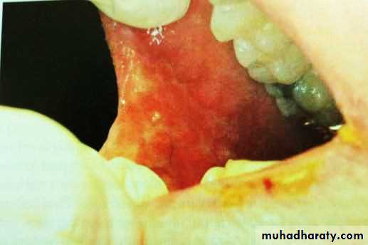 Ulcer